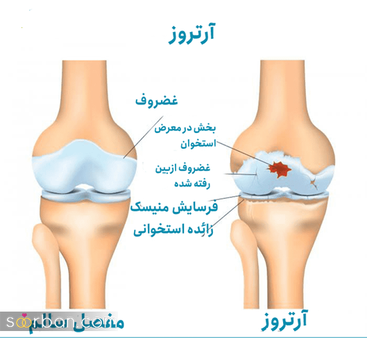 درمان آرتروز و 5 نکته مهمی که باید بدانید