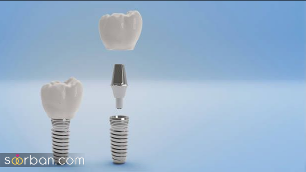 0تا 100 ایمپلنت دندان ؛ بهترین روش برای جایگزین کردن دندان های از دست رفته.