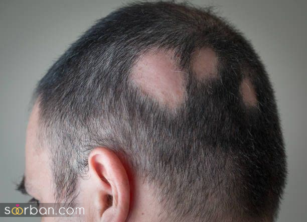 چرا موهامون میریزه ؟ + بررسی 9 علت شایع و مهم ریزش مو در زنان و مردان