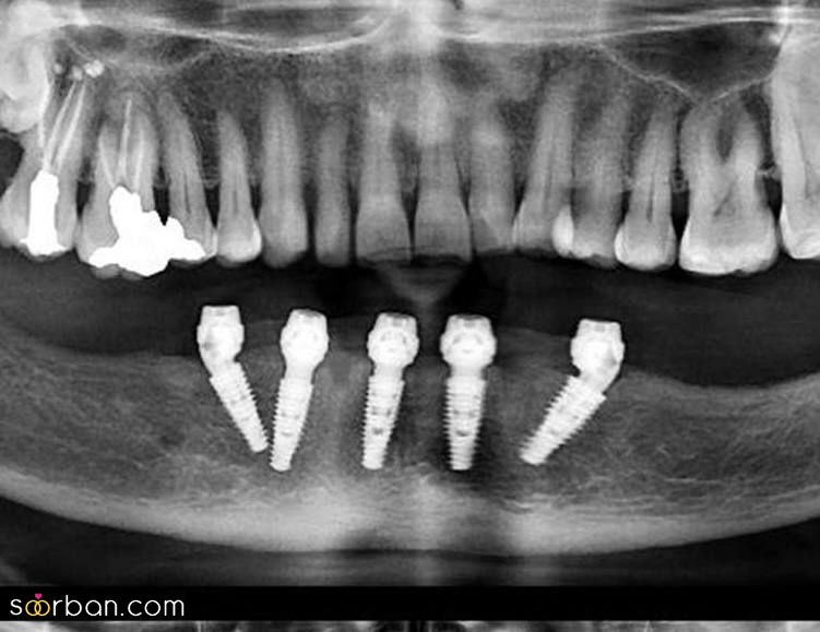 ایمپلنت دندان چگونه است؟