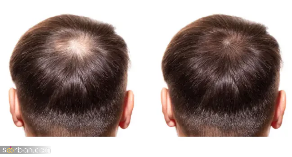 مزایای کاشت مو: بازگشت موهای از دست رفته و اعتماد به نفس