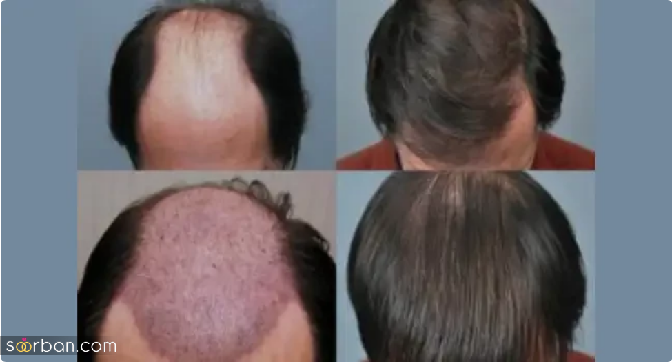 مزایای کاشت مو: بازگشت موهای از دست رفته و اعتماد به نفس