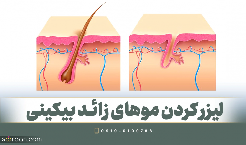 مزایا و معایب لیزر موهای زائد بدن