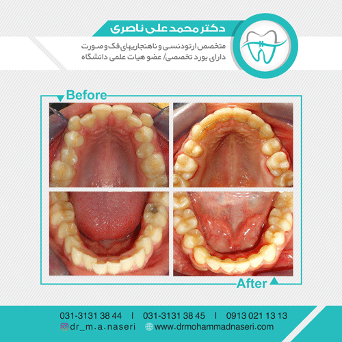 ارتودنسی چند دندان چگونه انجام می شود؟ 