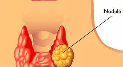 درمان ندول تیروئید با سیاه ‌دانه از شایعه تا واقعیت 
